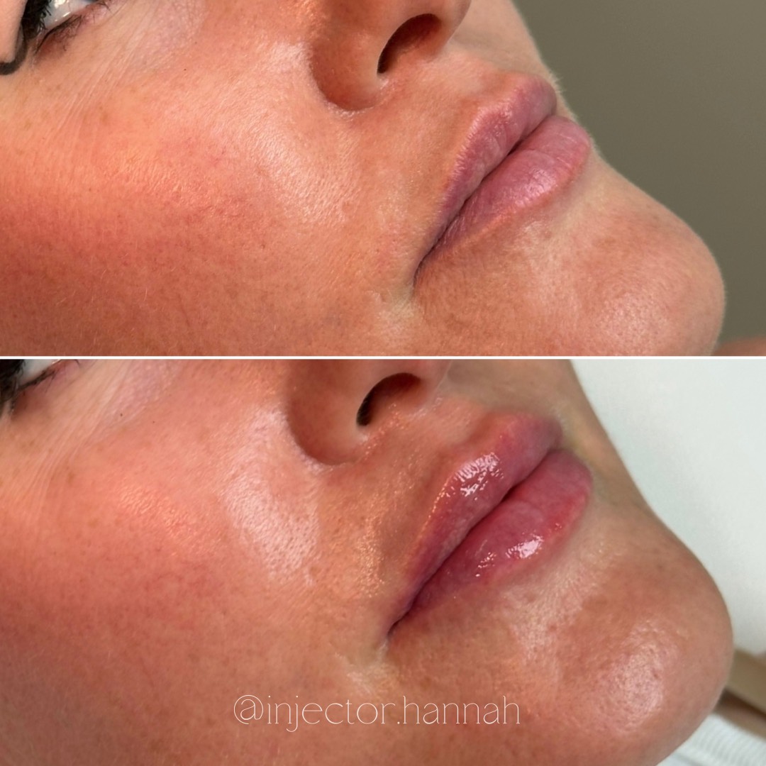 Forehead lines before/after – smoother after 2 weeks